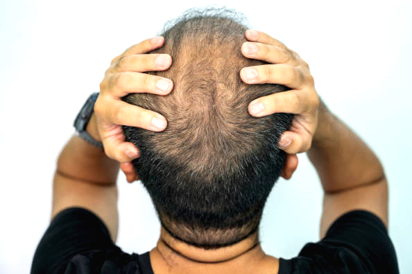 How to Stop Hair Fall for Men and Regrow Hair Naturally